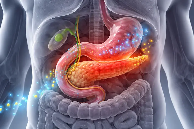 Illustrazione di una pancreatite acuta